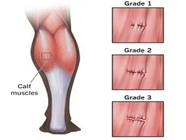 Calf muscle strain location