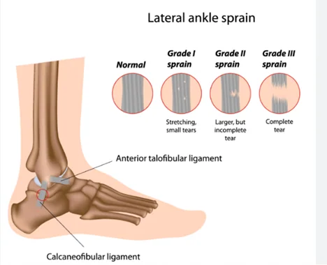 Ligament sprain care guidance