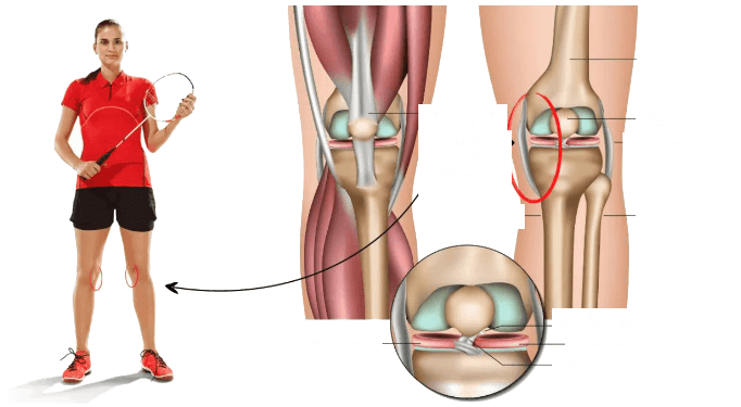 Medial collateral ligament injury anatomy